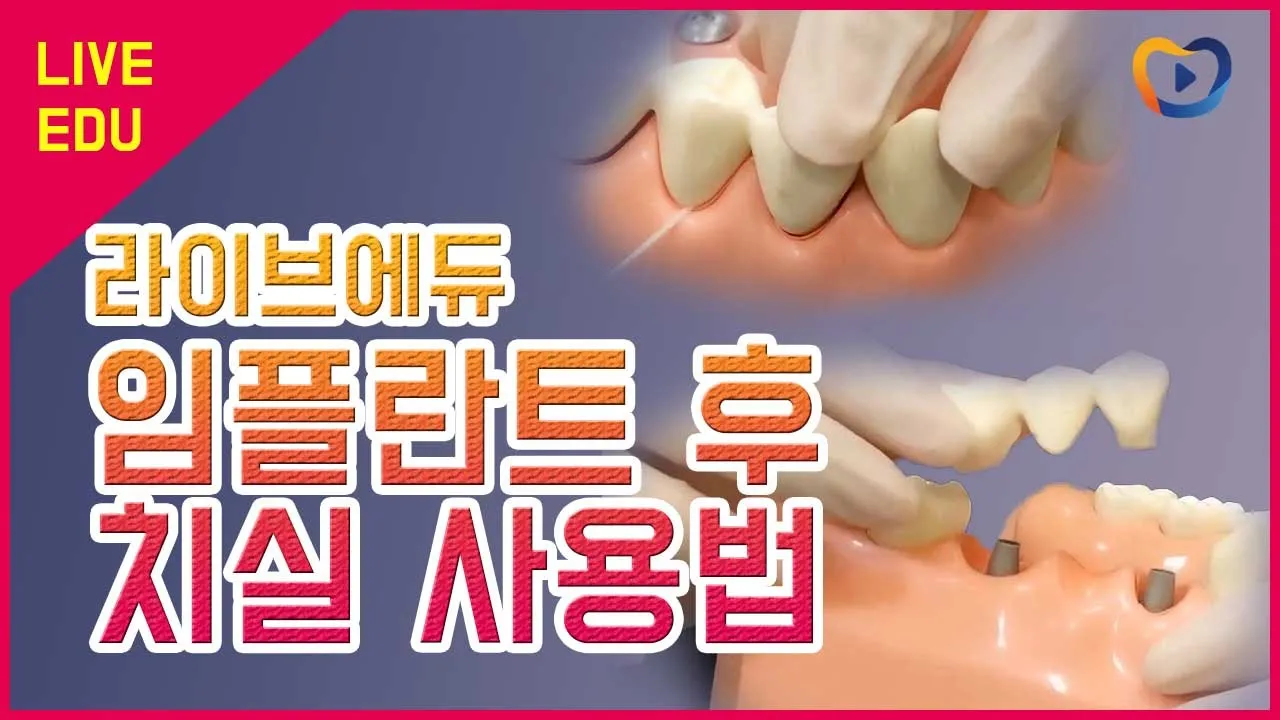 [라이브에듀]  임플란트 치실사용으로 수명연장!