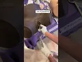 shows a forceps delivery