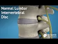Normal Lumbar Intervertebral Disc