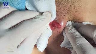 Điều trị mụn áp xe sưng viêm nhiều dịch mủ - Tại phòng khám da liễu HHV Clinic.