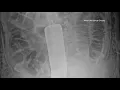 Baylor Scott White sued by patient who claims surgeons left metal retractor inside him