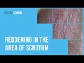 Reddening in the area of scrotum