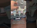 Knee replacement for arthritis