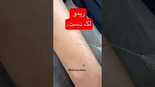 پاکسازی پوست دست از لک و خال با تکنولوژی روز نتیجه فوری 