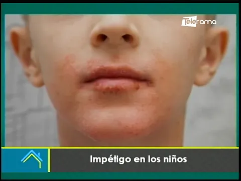 Impétigo en los niños