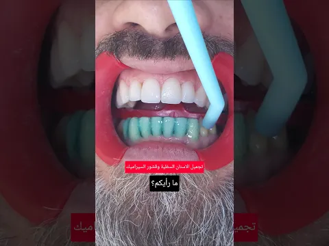 قشور السيراميك لتجميل الاسنان السفلية