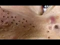 Loan Nguyen Acne Treatment 4