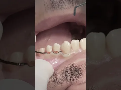 Composite restoration class V for 23,24,25 teeth #dentist