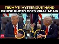 Download Lagu Trump suffering from severe illness? US President's new hand bruise photos ignite health speculation