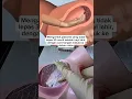Download Lagu Manual Removal of Placenta Explained