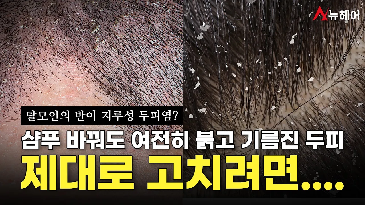 지루성 두피염 샴푸 바꿔도 소용 없다면 이렇게 해야 합니다 (비듬. 각질. 붉은 두피 치료법)