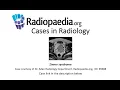 Download Lagu Zinner syndrome (Radiopaedia.org) Cases in Radiology