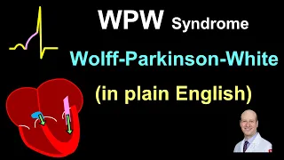 WPW Explanation And Treatment In Plain English 
