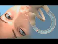 Epley Maneuver to Treat BPPV Vertigo