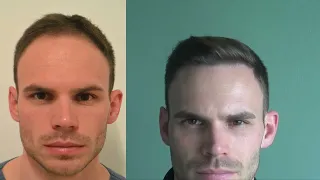 3616 FUE Hair Transplant Result - Hattingen Hair