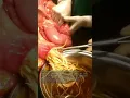 Download Lagu Can Ascaris lumbricoides | Round Worm Cause intestinal perforation? | #shorts #Surgery #laparotomy