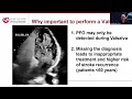Under Pressure Mastering Valsalva Maneuvers in Agitated Saline Studies