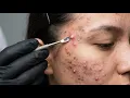Loan Nguyen Acne Treatment 32zz