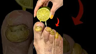 Get Rid Of Fungus Forever With Lime A Doctor Shared This Simple Recipe With Me 