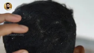 big flakes scalp scratching and picking 013