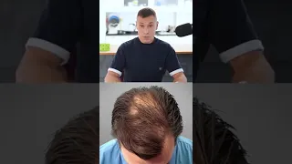 Скрытые причины выпадения волос 