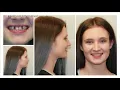 Dr Lugakingira Missing Lateral Incisors Dental Implants WPTA ABC 21