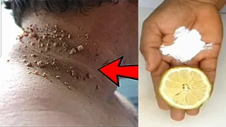 remove skin tag with 1 ingrediant strong remedies for skin tags 2