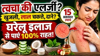त्वचा की एलर्जी, खुजली और लाल चकत्ते का घरेलू इलाज | Skin Allergy Home Remedies in Hindi