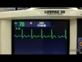EKG Training Watching and Interpreting the Defibrillator Monitor