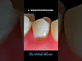 Unbelievable Tooth Repair in Seconds