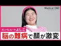 Download Lagu ガンバレルーヤよしこ、先端巨大化する「難病」の発覚。“視力喪失”の恐怖とは【闘病】
