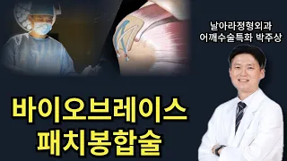 바이오브레이스 패치봉합술 어깨 회전근개파열 치료