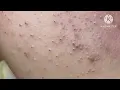Super blackheads
