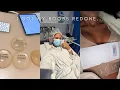 I GOT MY BOOBS DONE AGAIN Breast Revision Surgery 2 week update