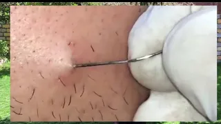 علاج الشعر تحت الجلد حل نهائي تنظيف البشره His Hair Is Under The Skin 