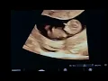 Fetus 11 weeks Ultrasound shows movements nasal bone crown rump length - Dr Kagan Kocatepe