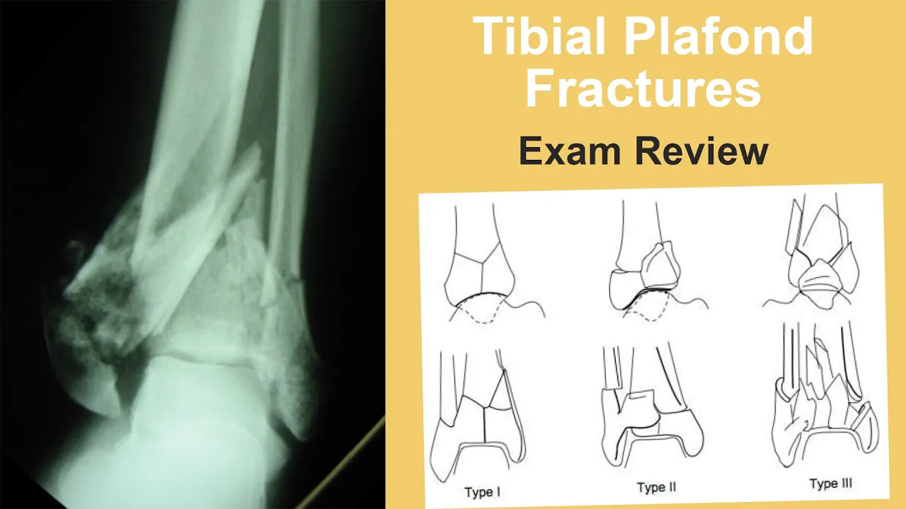 TKA: Varus Knee with Anterior Referencing and Gap Balancing Technique - Dr. Stephen Incavo. 