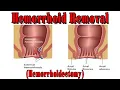 Hemorrhoidectomy CPT code - simplify medical coding