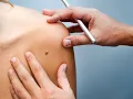 Excision of Lesion CPT code - simplify medical coding