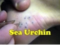 Download Lagu Sea Urchin Spine Sting Removal Attempt - Maui Hawaii - Daredevil Girl