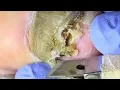 Download Lagu 😱 | SATISFYING ASMR FUNGUS TOENAILS REMOVAL ⚡Tips | Rainy Day ASMR: Birdsong \u0026 Gentle Forest Sounds