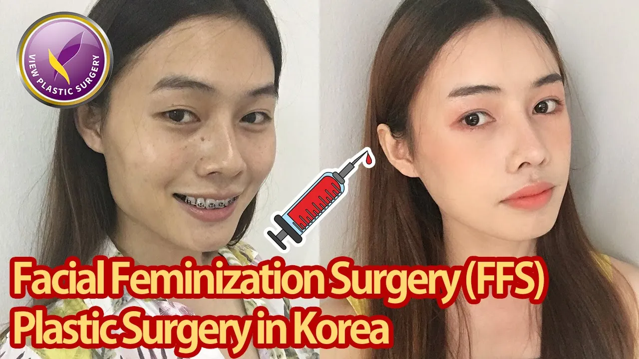 【View Plastic Surgery】 Transgender FFS in Korea