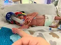 Download Lagu Born At 24 Weeks: Christopher's Birth Story