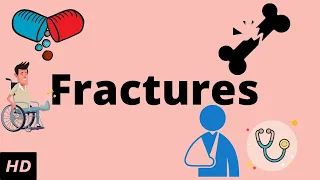 Download Fractures, Causes, Signs and Symptoms, Diagnosis and Treatment. MP3