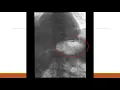 MSC Percutaneous Gastrostomy Tube Placement
