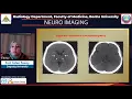 Differential diagnosis for bilateral abnormalities of the basal ganglia and thalamus