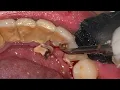 Download Lagu PROSES PEMBERSIHAN KARANG GIGI | Dentist | Dokter Gigi Tri Putra
