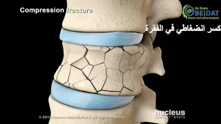 الدكتور بدر عبيدات  علاج كسور الفقرات عبر الجلد بدون جراحة دندنها