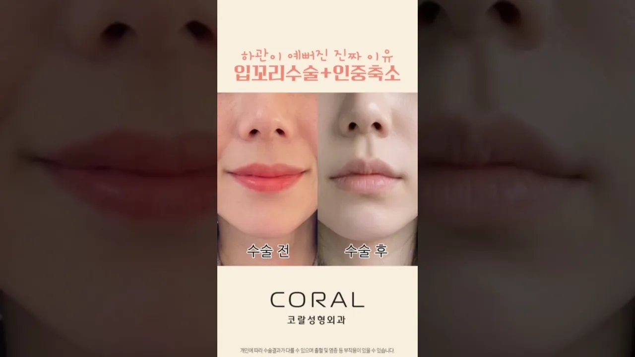 무표정인데 인상 예뻐졌다는 소리 듣는 법 💋 #shorts #인중축소 #입꼬리수술