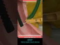 Download Lagu ERCP - Pancreatic Ductal Stone Removal ↪ 3D Medical Animation #Shorts #Pancreatic #Stone #ERCP